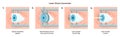 LASIK eye surgery. Patient receiving optical correction with a laser.