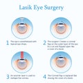 Lasik eye surgery. Vector Illustration Royalty Free Stock Photo
