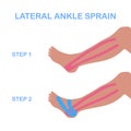 Lateral ankle sprain. Correct kinesiology taping.