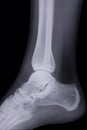 Lateral ankle x-ray