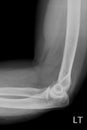 Lateral elbow x-ray Royalty Free Stock Photo