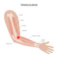 Lateral epicondylitis tennis elbow