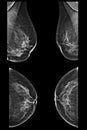 Lateral mammogram of female breast