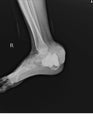 Lateral Right foot X-ray showing destruction of the posteroinferior aspect of the calcaneus Royalty Free Stock Photo