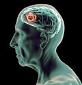 Lateral view of a brain of an elderly man. Tumor. Degenerative diseases, Royalty Free Stock Photo