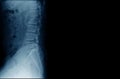 Lumbar spine x-ray image