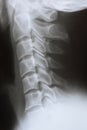 Lateral x-ray of the neck and cervical spine of a person Royalty Free Stock Photo