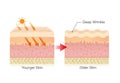 Layer of normal skin and cancer cell spreading in vector style.