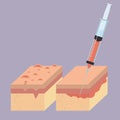 Layers of skin with botox injection