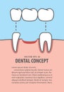 Layout Bridges teeth real root illustration vector on blue background. Dental concept.