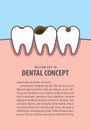 Layout Caries and cavity teeth illustration vector on blue background. Dental concept. Royalty Free Stock Photo