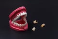 Layout of the human jaw and extracted sick teeth Royalty Free Stock Photo