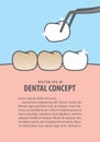 Layout Putting new veneer on discolored tooth illustration vector on blue background. Dental concept