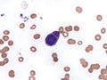 A LE cell (lupus erythematosus cell) in bone marrow.