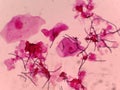 LEADURIFFORM CELLS (HYFAS) IN BIOLOGICAL SAMPLE. Gram color.