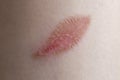 Leaf shaped burn wound on a woman\'s fore arm, macro skin texture