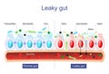 Leaky gut. Intestinal permeability. Gut barrier dysfunction Royalty Free Stock Photo