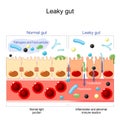 Leaky gut Royalty Free Stock Photo