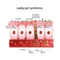 Leaky gut syndrome.