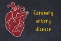 Learning cardio system concept. Chalk drawing of human heart and inscription Coronary artery disease