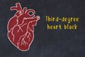 Learning cardio system concept. Chalk drawing of human heart and inscription Third-degree heart block Royalty Free Stock Photo