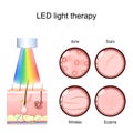 LED light therapy for Acne treatment, Scars, and Wrinkles reduction, and Eczema management