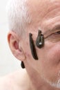 Leech therapy Royalty Free Stock Photo
