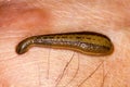 Leech treatment Royalty Free Stock Photo