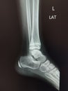 Left ankle x-ray lateral view normal bone and swelling soft tissue, Medical image concept. Royalty Free Stock Photo