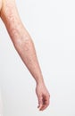Left arm with red skin capillary network