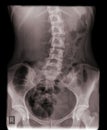 Left convex spine