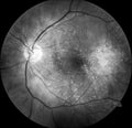 Left eye with familial autosomal dominant drusen