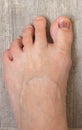 Left foot on the floor. Damaged nail. Bruise under thumb nail. Barefoot close up. Nail illness. Health treatment. Royalty Free Stock Photo