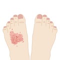 Left foot scratches because of itching from infection fungus or tinea versicolor, illustration on white background