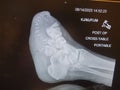 Left foot transmetatarsal amputation with staples - plain x-ray