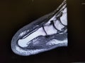 Left foot transmetatarsal amputation stump - MRI image