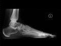 Left foot X-Ray