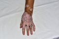 Left hand injured by vitiligo disease.