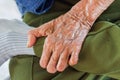 Left hand of a leprosy