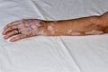The left hand of an old woman damaged by the disease vitiligo. Royalty Free Stock Photo