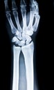 Left hand x-ray Royalty Free Stock Photo