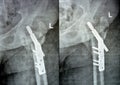 Left hip trans cervical neck of femur fracture fixated by DHS Dynamic Hip Screw, Plain x ray PXR of an old patient, a femoral head