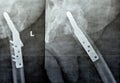 Left hip trans cervical neck of femur fracture fixated by DHS Dynamic Hip Screw, Plain x ray PXR of an old patient, a femoral head