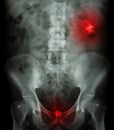 Left kidney stone(opaque area at right upper of image) and bladder stone(opaque area at lower of image )