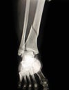 Left leg broken.Film x-ray left leg show tibai bone broken Royalty Free Stock Photo