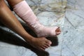 Left legs and feet be in plaster cast because splintered. Royalty Free Stock Photo