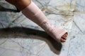 Left legs and feet be in plaster cast because splintered. Royalty Free Stock Photo