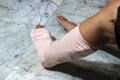 Left legs and feet be in plaster cast because splintered. Royalty Free Stock Photo