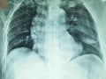 Left lung pneumothorax in patient with trauma