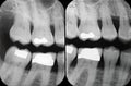 Left Periodontal X-rays Royalty Free Stock Photo